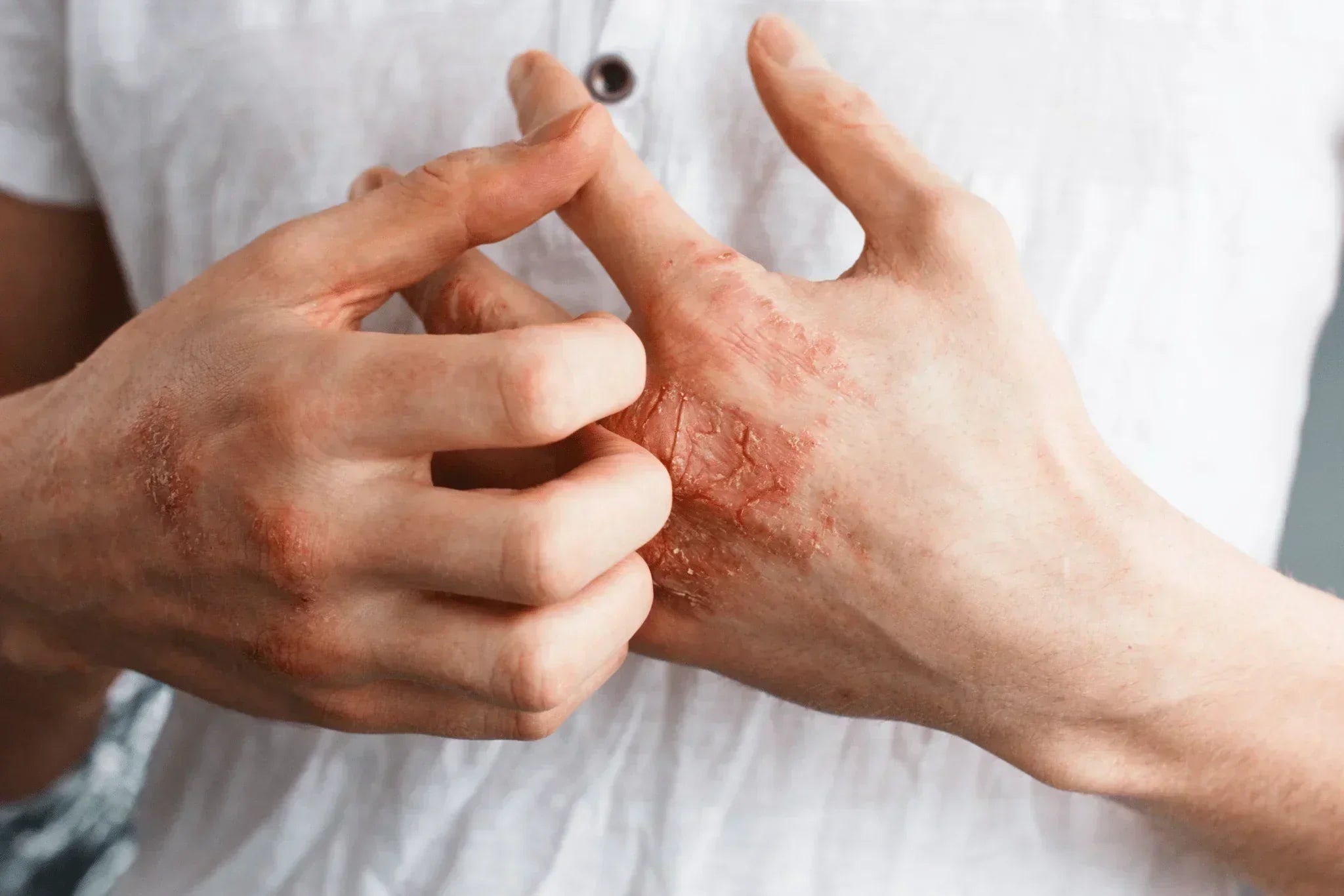Eczema Treatment