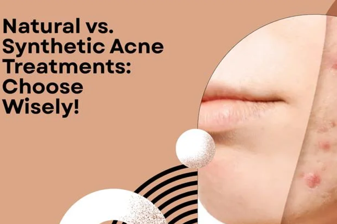 Natural vs. Synthetic Acne Treatments